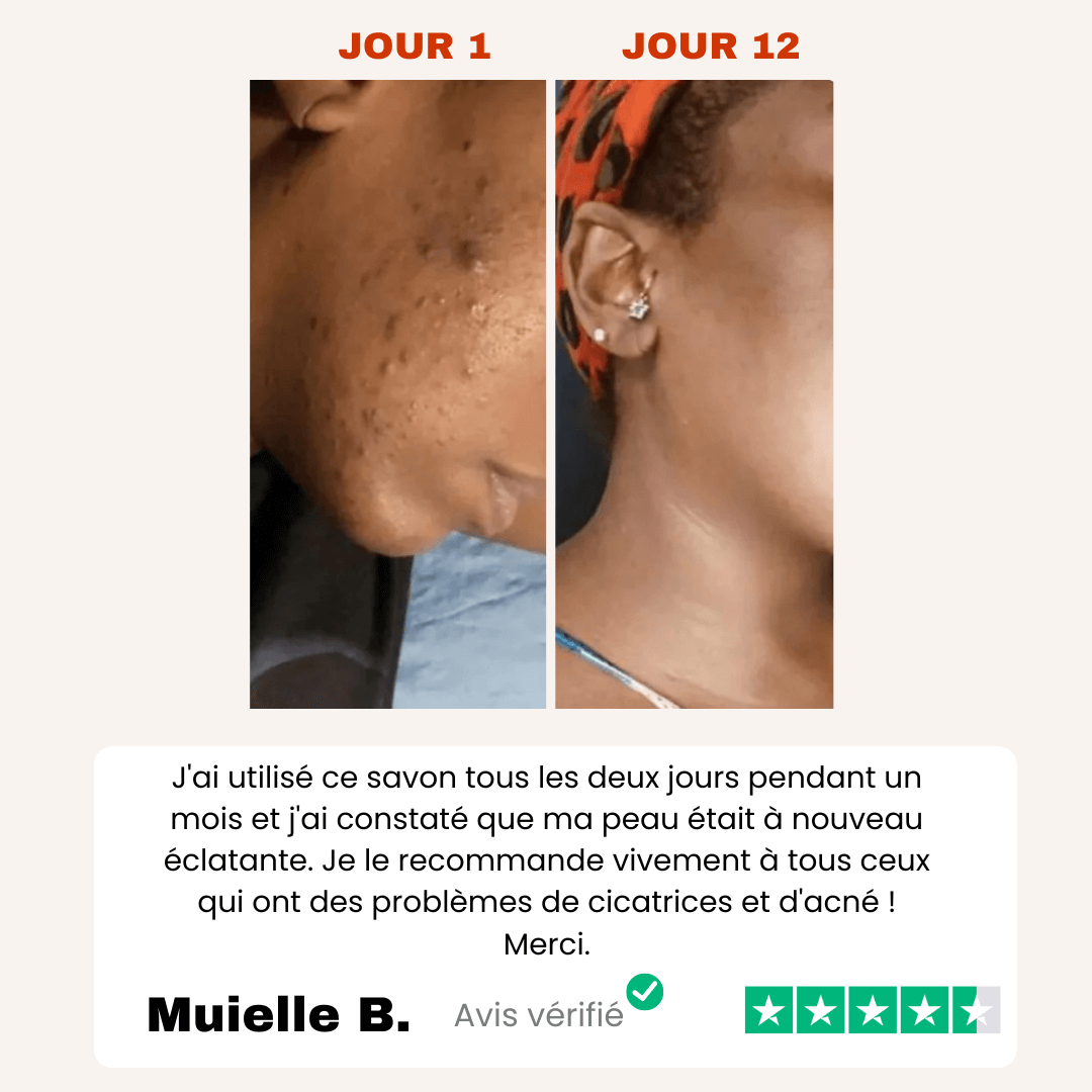 Savon Anti-Taches 100% naturel au Curcuma