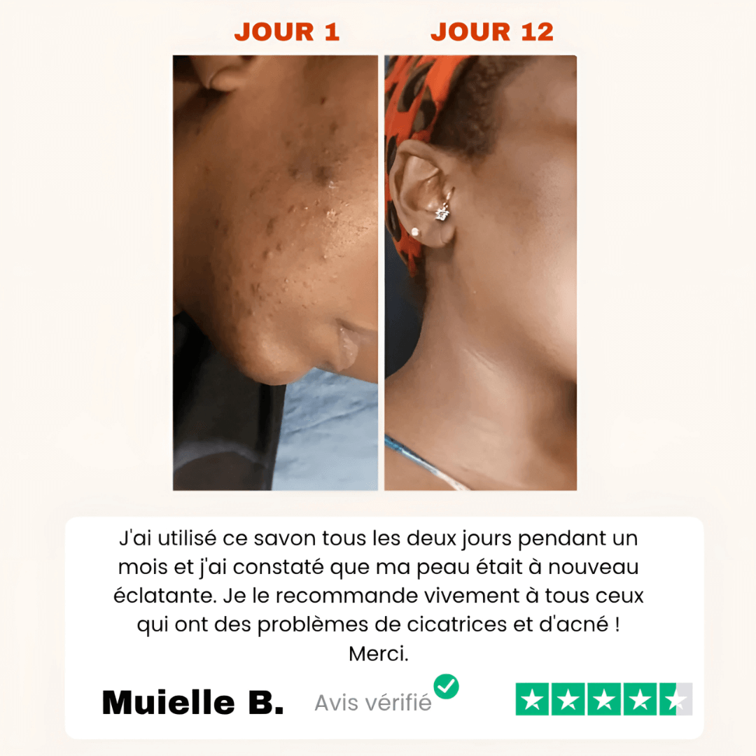 Savon Anti-Taches 100% naturel au Curcuma